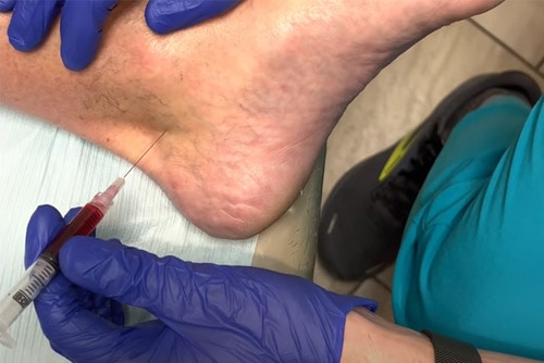 B12 injection into foot
